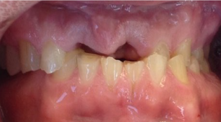 Dental implants and Invisalign before treatment